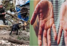 120 people have died so far in Texas floods, 170 are still missing; now measles has become a new problem in America
